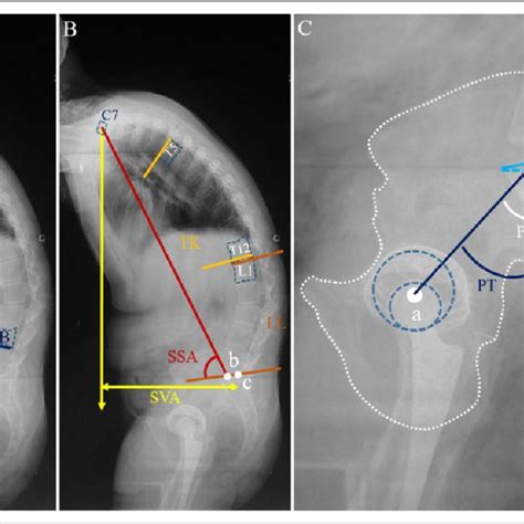 Chin Brow Vertical Angle Cbva In A Lateral Photograph Draws A Line