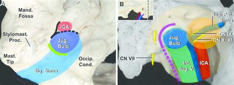 Jugular Foramen Approaches The Neurosurgical Atlas