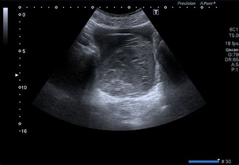 Radiopaedia Case Urinary Bladder Hematoma Id 59790 Study 67257 NC