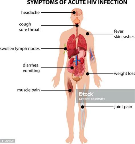 Vetores De Diagrama Mostrando Sintomas De Infecção Aguda Pelo Hiv E
