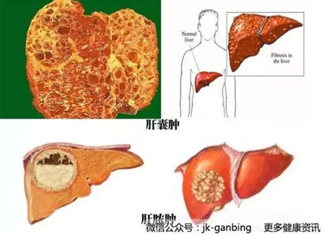 肝囊腫與肝膿腫有何區別 每日頭條