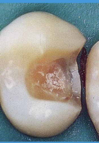 Fpd Tooth Colored Inlays And Onlays Flashcards Quizlet