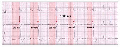 Unusual ventricular ectopy - Resources