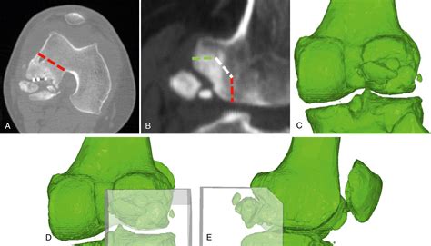 Computed Tomography Of The Knee Joint Indications And Significance