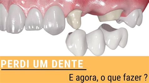 Perdi Um Dente E Agora O Que Fazer Youtube