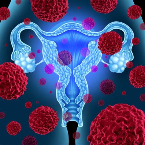 An Overview Of Endometrial Cancer Womb Cancer Uterine Cancer Causes Symptoms And