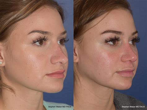 Revision Rhinoplasty Before And After 19 Weber Facial Plastic Surgery