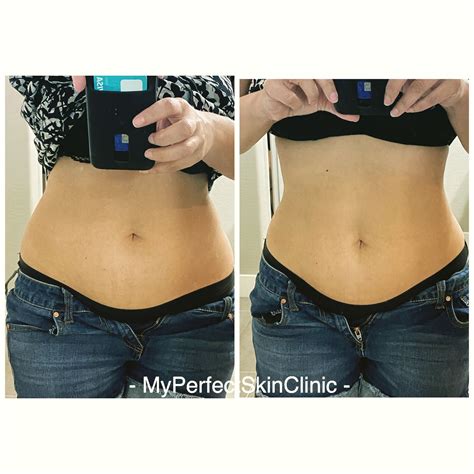 Body Contouring Treatment Body Sculpting Coolsculpt Gilbert Az