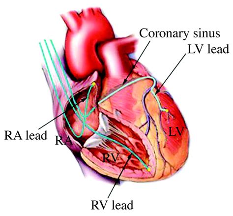 New Pacing Technologies For Heart Failure The Bmj