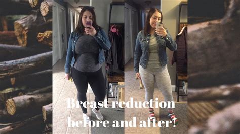 Breast Reduction Before After Pictures Youtube