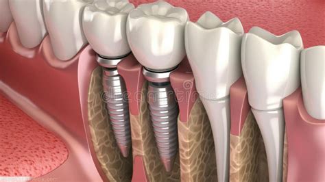 Visual Representation Of Dental Implants In Jawbone Different Types Of