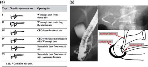 (a) Yogi et al. described six types of annular pancreas according to... | Download Scientific ...