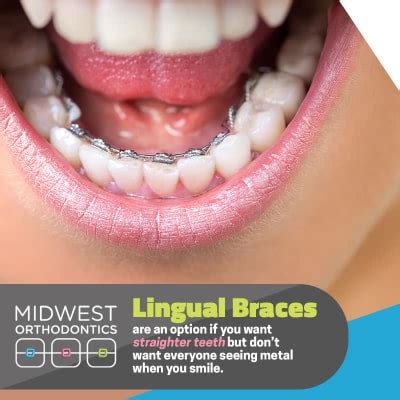 Do Lingual Braces Take Longer Than Regular Braces Midwest Ortho