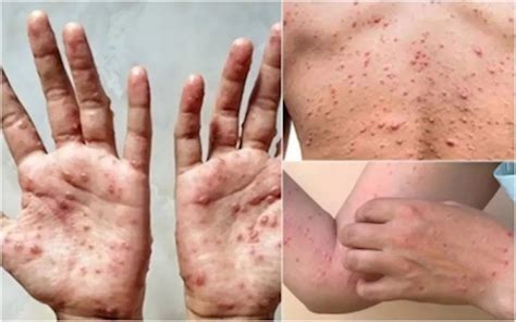 Moh Confirms Suspected Mpox Cases Negative Screening Ongoing At