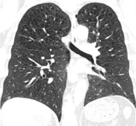 Visual Emphysema At Chest Ct In Gold Stage Cigarette Smokers Predicts