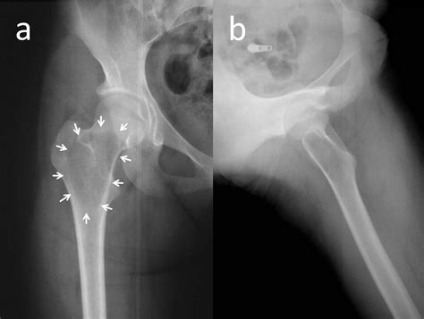 Aneurysmal Bone Cyst Histology