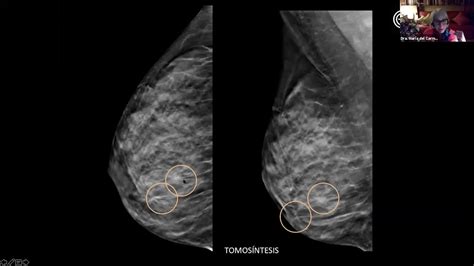 Resonancia Magn Tica Mamaria Youtube