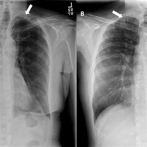 Posteroanterior Pa Chest Radiograph For Case Number A Years