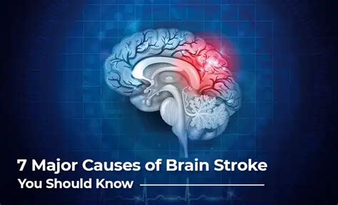 Top 7 Causes of a Brain Stroke - Major Risk Factors and Prevention