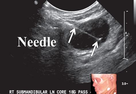 Us Guided Biopsy Of Neck Lesions The Head And Neck Neuroradiologists