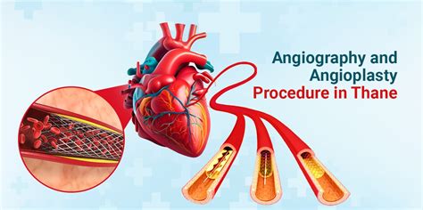 Jinkushal Hospital Your Complete Guide To Angiography And Angioplasty