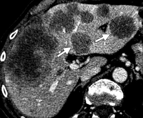 Multiple Hepatic Metastases From Colorectal Cancer In A 66 Year Old Download Scientific Diagram