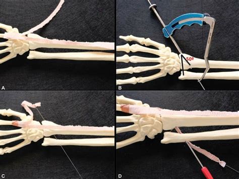 Schematic Representation Of The Technique A Extensor Carpi Radialis Download Scientific