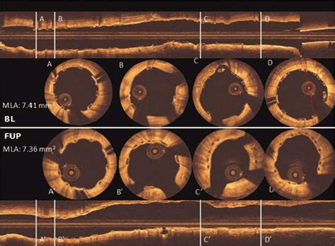 First In Human Evaluation Of A Novel Poly L Lactide Based Sirolimus