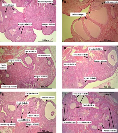 Polycystic Ovary Histology