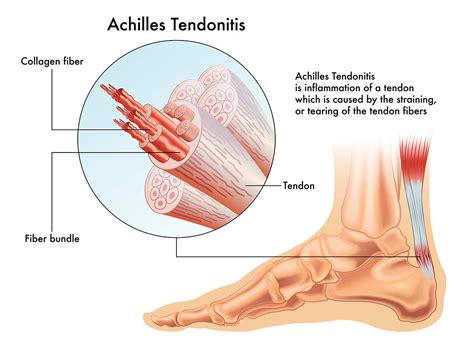 achilles-tendonitis | Nova foot