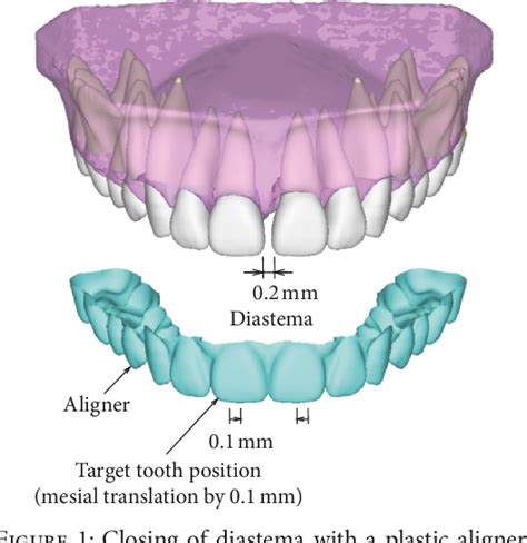 Figure 2 from Effects of Attachment of Plastic Aligner in Closing of ...