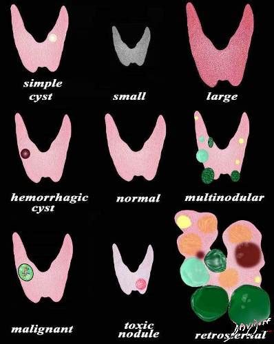 Types Of Thyroid Nodules