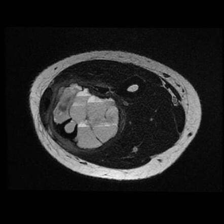 Subperiosteal Aneurysmal Bone Cyst Ulna Radiology Case