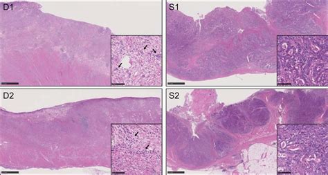 Hematoxylin And Eosin Hande Staining Of Gastric Cancers Used In