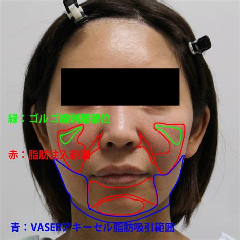 【ゴルゴ線治療】★167 頬あご下vaserアキーセル ゴルゴ剥離 脂肪注入 シンシア総院長ブログ～sincerely Yours 銀座の