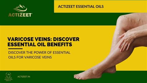 Varicose Veins Discover Essential Oil Benefits