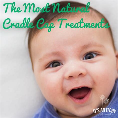 The Most Natural Cradle Cap Treatments (and Seborrheic Dermatitis)