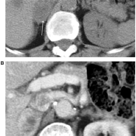 A Non Contrast Enhanced Ct In A 45 Year Old Man With Refractile Download Scientific Diagram