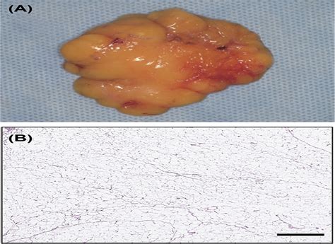 Liposarcoma Preoperatively Diagnosed as Lipoma: 10-Year Expe ...