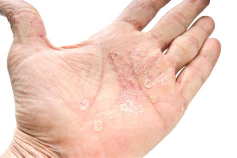 Is There A Link Between Psoriasis And Diabetes YourCareEverywhere