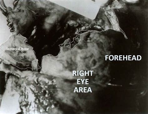 JFK Autopsy Photo decoded? - JFK Assassination Debate - The Education Forum
