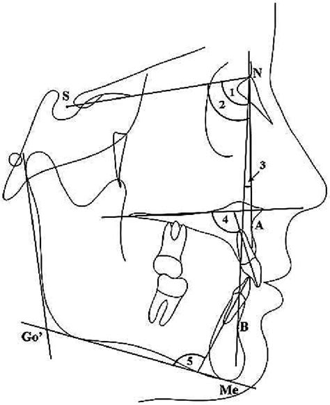 Cephalometric Measurements 1 Sna Angle 2 Snb Angle 3 Anb