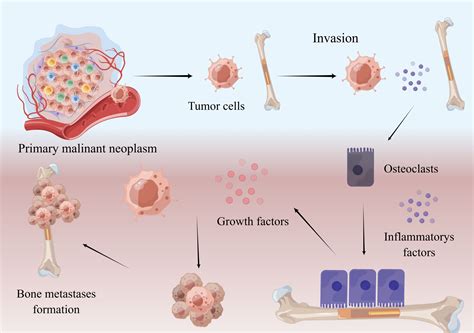 Frontiers Management Of Pain In Patients With Bone Metastases