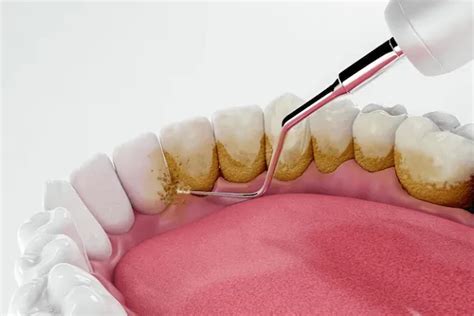 Conoce más sobre el sarro dental - P&P Clinic