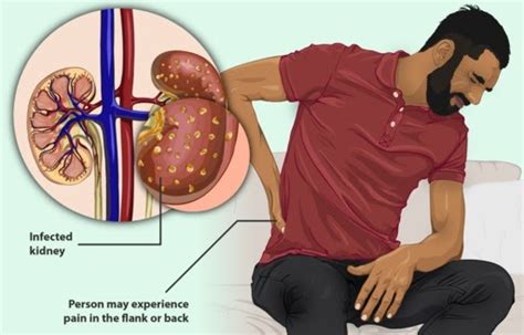 Askep Pasien Pielonefritis Akut Repro Note