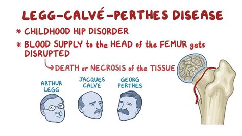 Legg-Calve-Perthes disease: Video, Anatomy & Definition | Osmosis