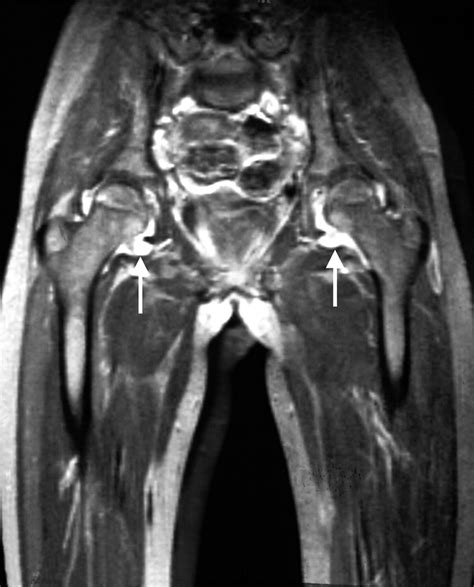 Juvenile Idiopathic Arthritis Xray