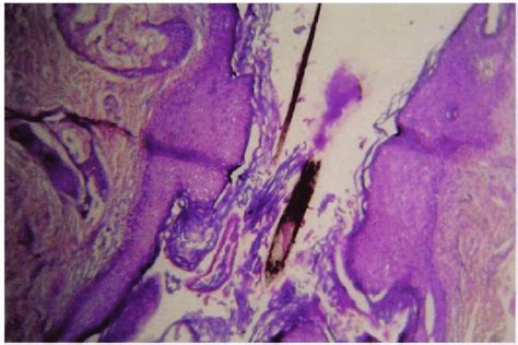 Histological Section Of The Pilonidal Sinus Tract Stratified Squamous Download Scientific