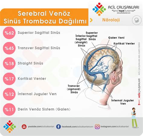 Serebral Ven Trombozu Sinüs Acil Çalışanları