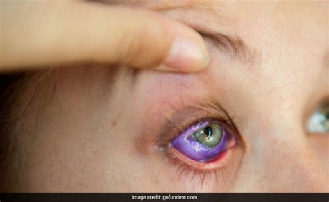 A Model Tattooed Her Eyeball Purple. She Now Could Lose Her Eye.